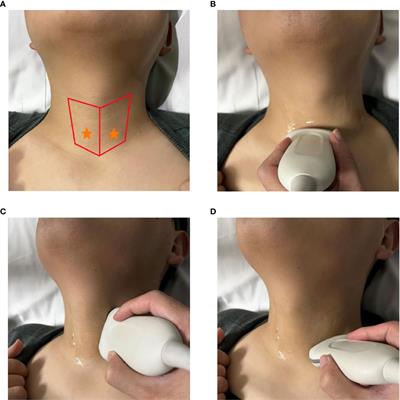 Preoperative ultrasound identification and localization of the inferior parathyroid glands in thyroid surgery